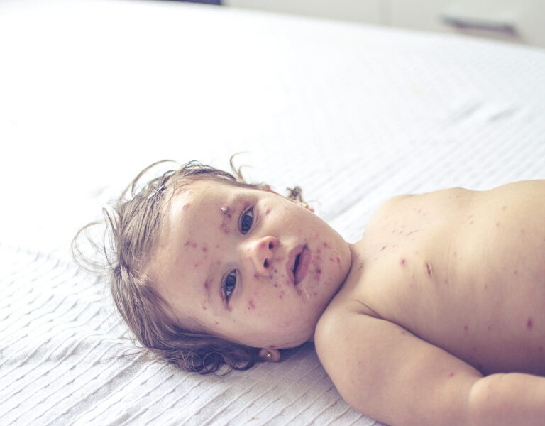 হামের লক্ষণ ও প্রতিকার